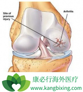 û�г��ֶ෢�Թ�����֢״�Ļ�����Ҫ�������ǶȰ�������