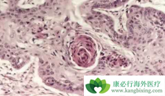 ���۰����߷��ð�������(AFATINIB)���OS��PFS����������