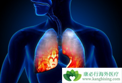 ��������(GILOTRIF)��ʹ����EGFR-TKI����ʧ�ܵķ��ٰ�����