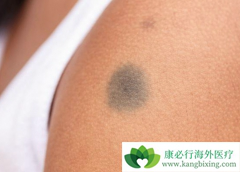 �˽���ЩƤ����֢״���Ա��Ⱙ֢����