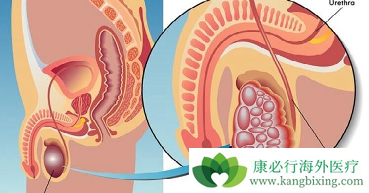 睾丸癌症状 睾丸癌症状