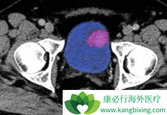 PD-L1���Ƽ�Tecentriq����Ч�ԺͰ�ȫ�Եõ����ٴ���֤