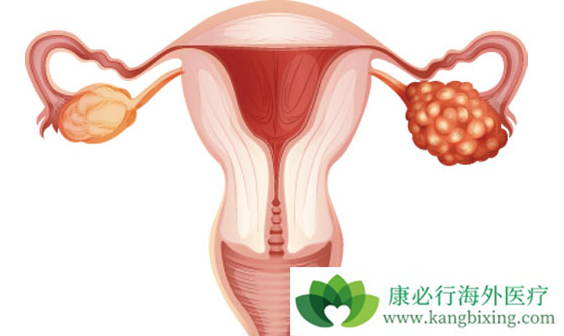 卵巢癌 卵巢癌