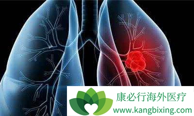 肺癌 肺癌