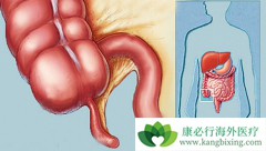 ��������(Capecitabine)���ձ�III�ڽ�ֱ�������ߵı�׼���Ʒ���