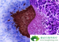 ���޻�(Rituximab)�������GPA�����׳��ֵͱ����򵰰�Ѫ֢