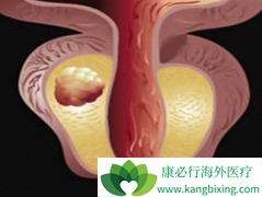 ��������(Abiraterone)���ϱ�׼�Ʒ�������ΪmCRPC������ѡ�Ʒ�