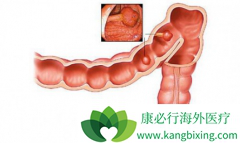 ������(REGORAFENIB)������ʹ�᳦�����߻���˸�����λ����ʱ��
