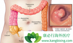 SNPs����ɳ��(Eloxatin)/��ɳ�����������ƽ᳦��������OXPN���