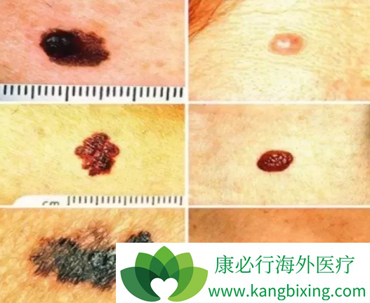 ��ɫ��������֢״