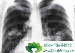 �ΰ�ҩ�Ｊ������(GEFITINIB)�Էΰ����ߵ����߹����и�������