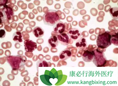 ΪʲôӢ��NICE��������������(nilotinib)���ڶ���CML����