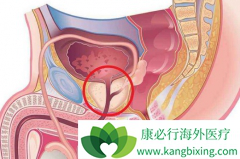 ǰ���ٰ����߷��ð�������(XBIRA)�������ز�����Ӧ�ĸ����Ƕ���