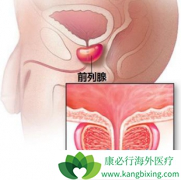 ����ǰ���ٰ����߿��Է��ð�������(Zytiga)��