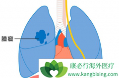 ������/���������뼪������һ��������EGFR��������ͻ������NSCLC