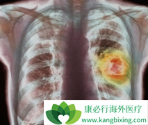 ���̵ķΰ����߿��Է��ð���ҩ�Ｊ������(GEFITINIB)��