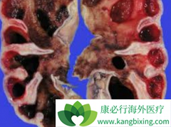 �������ڷ��ð���ҩ����������(sutent)���ܻ���