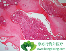 ��ϣ��(Nilotinib)����������������Ѫ������Ӧ����δ���