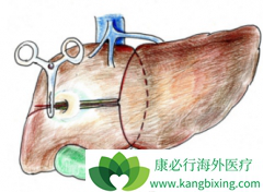 ��������(SORAFENIB)����TACE��������������ΰ�����