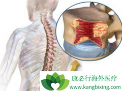 ���ڹ�����֢״����Щ���������ѡ�����ƹ�������ҩ�