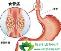 ��ķ����(Pembrolizumab)����θʳ�ܽ����԰�֢��Ч����ô��