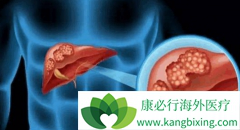 ��������(Inlyta)����TACE�������Ƹΰ����������VEGF����