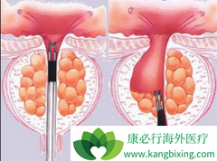 Ϊʲô��������(ABIRATERONE)��ҩ��������ǰ���ٰ�����