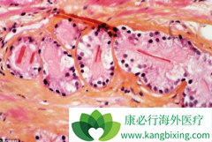 Ϊʲô���߷��ð�������(ABIRATERONE)ǰ��Ҫ���ι���