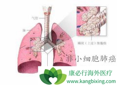 ��Сϸ���ΰ��Ĺ�ת�Ƶ�֢״��ʲô����������ƣ�