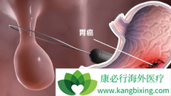 ��Ī¬����(Ramucirumab)����mFOLFOX6�����ܷ����ITT��Ⱥ��PFS