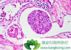 ��ķ����(Keytruda)��ҩ����PD-L1�ͱ������·��Ƥ��Ч������