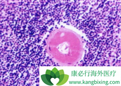 ���޻�(RITUXAN)������³���������ط��Ծ��򵰰�Ѫ֢Ч������