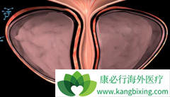 Ϊʲô����ǰ���ٰ����߸�ƫ��ӡ�Ȱ�������(ABIRATERONE)