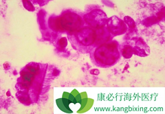 ���ᵥ��(Panitumumab)���ϻ����������������ٰ���Ч����