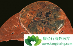 �̿����Ƶ��ַ�����(Lenvima)������ΰ����߶���������