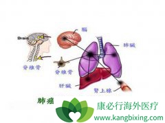 �ΰ���ת��֢״��������ת�Ƶĳ�����λ