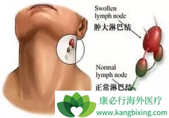 �����ܰͰ���ʲô�������ܰͰ�֢״����Щ��