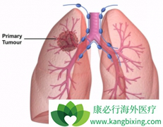 ����ͻ�为�ɣ�TMB���Ƿ��Ӱ���Сϸ���ΰ����ߵ�Ԥ��