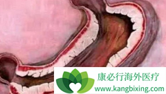 ��׼�����������鵥��(Herceptin)��ʹ���߻�ø��õ�������