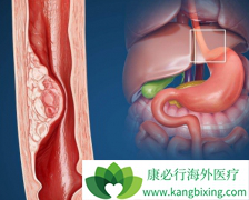 ���޿�(ERLOTINIB)���ϳ���������������ʳ�ܰ����ߵ���������