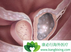 ��������(Abiraterone)����Ч����ǰ���ٰ��������ںϳ��ۼ��ص�ø