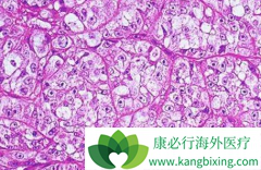 ��������(Olaparib)ʹ�ѳ������ߵļ�����չʱ���Ӻ��˽�����