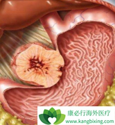 ������/�������Ḩ������GIST�����ܸ����޸�����������