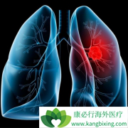 PD-1ҩ����ķ����(Keytruda)��ȡ�����Ƴ�Ϊ���ڷΰ���һ���Ʒ�