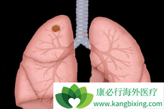 ��������(alecensa)����ALK���Էΰ���������Щ����