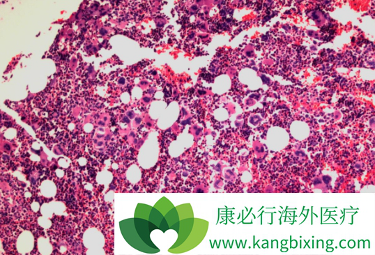 鲁索替尼 鲁索替尼