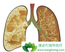 ������ͪ(pirfenex)����Ч���Ʒΰ��������ά���Ľ�չ