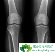 ���ټ����ĵ�ŵ����(denosumab)���������ͻ��߶��ι��۷���