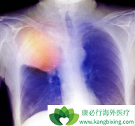 ��������(Lorlatinib)����ת�ƻ��ߵ���Ч�ʸߴ�90%