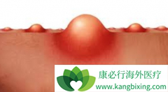 ����֯�����Կ�Ѫ��ҩ����ҩ��ɿ���PD-1����